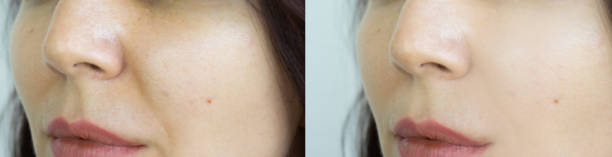 woman face wrinkles before and after treatment