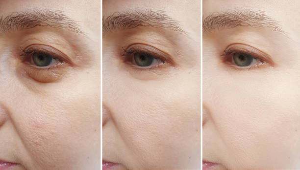 woman face wrinkles before and after treatment collage