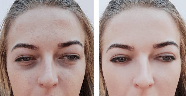 girl wrinkles eye bags before and after procedures