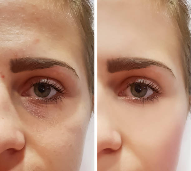 beautiful girl wrinkles on face before and after procedures