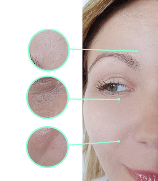 woman face wrinkles before and after treatment