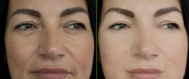 woman face wrinkles before and after treatment