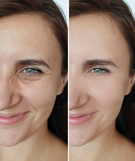 woman face wrinkles before and after treatment, collage
