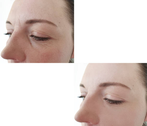 female face wrinkles before and after procedures