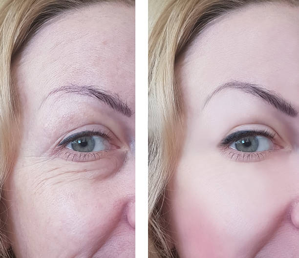 female eye wrinkles before and after treatments