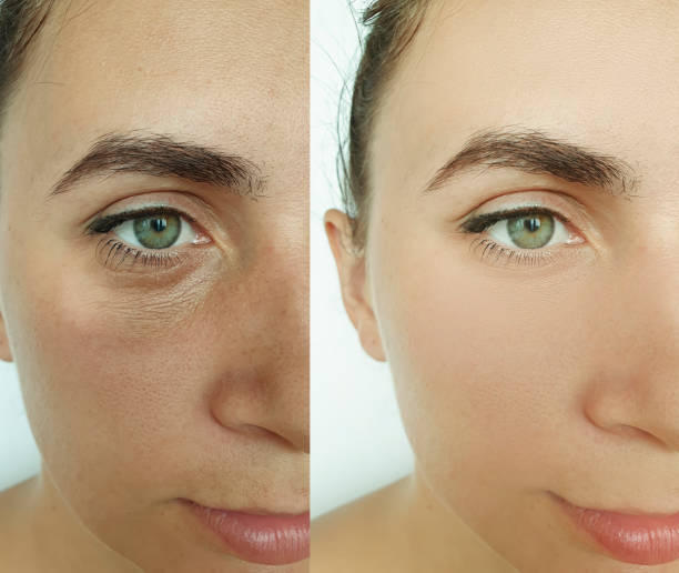 woman face wrinkles before and after treatment collage