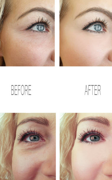 woman wrinkles face before and after procedures, removal
