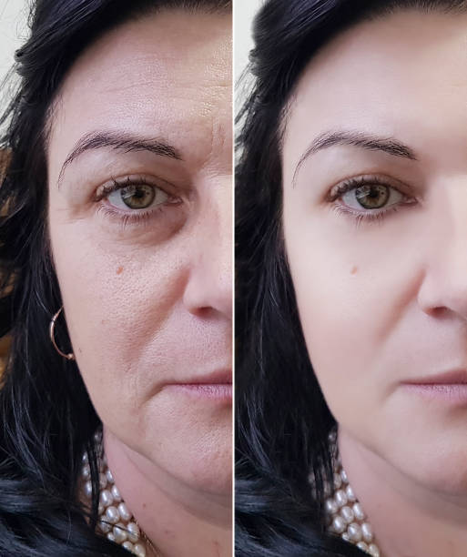 woman face wrinkles before and after