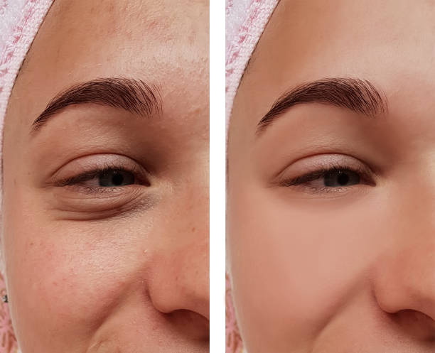 girl eye treatment, before and after procedures, acne