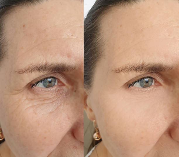 woman face wrinkles before and after treatment