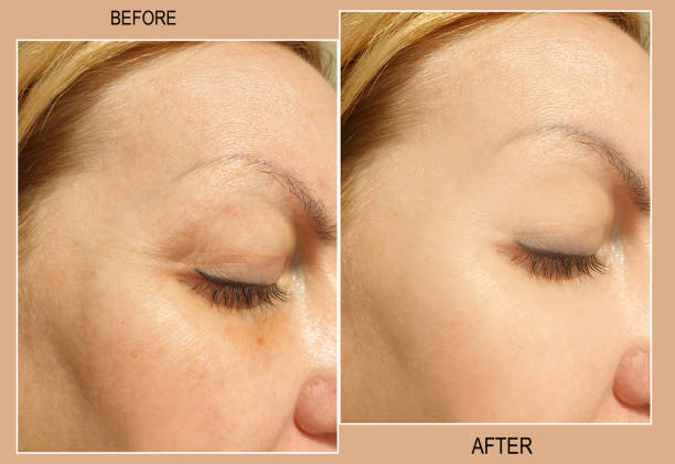 woman eyes wrinkles before and after treatment