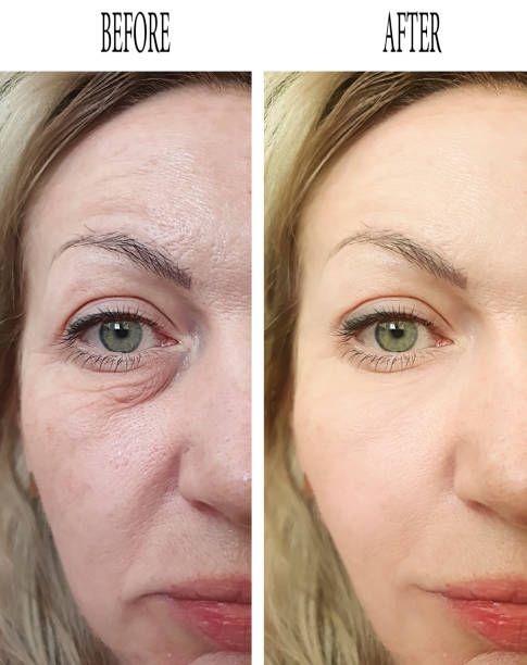 woman face wrinkles before and after collage treatment
