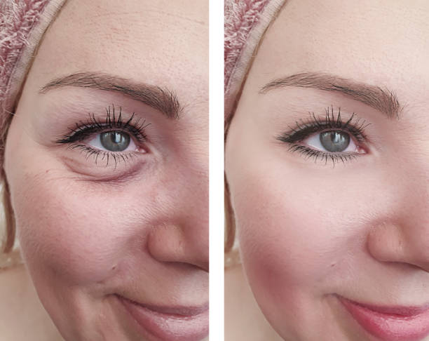 woman wrinkles before and after correction procedures