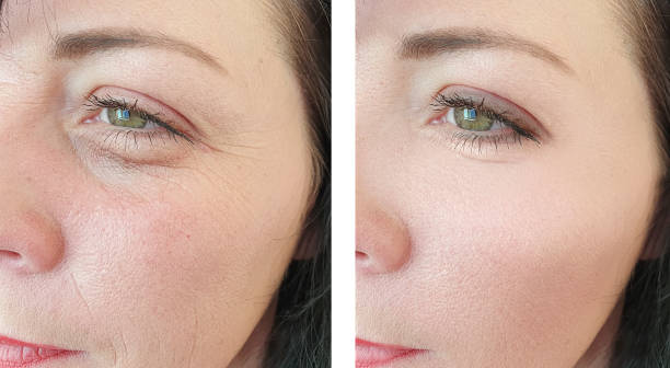 woman wrinkles face before and after treatment