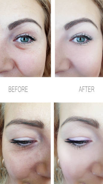 woman wrinkles face before and after procedures, removal