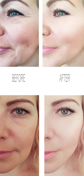 woman wrinkles face before and after procedures, removal