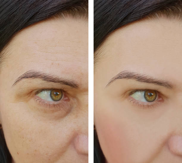 face woman wrinkles before and after cosmetic anti-aging procedures