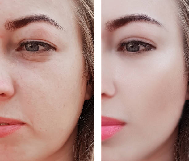 girl wrinkles eyes before and after procedures