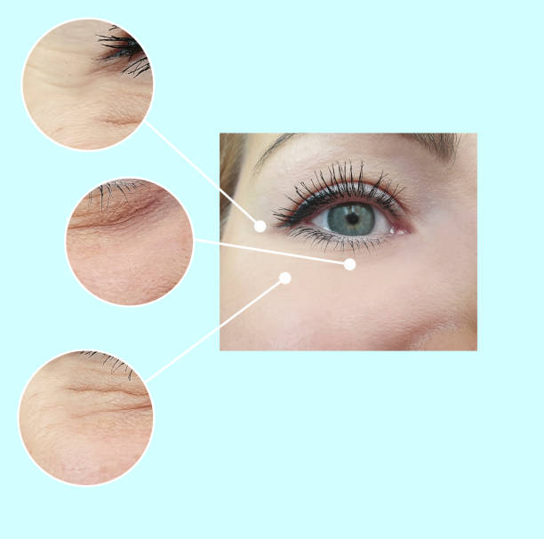 woman face wrinkles before and after collage treatment