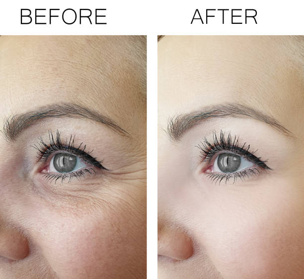 woman wrinkles before and after procedures