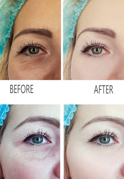 woman wrinkles before and after procedures