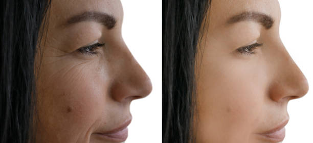 woman face wrinkles before and after treatment