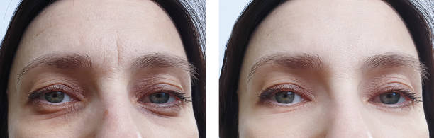woman face wrinkles before and after treatment