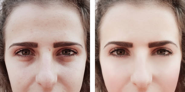 girl wrinkles eyes before and after procedures bags
