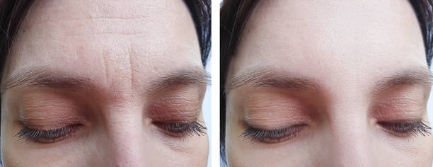 female forehead wrinkles before treatment