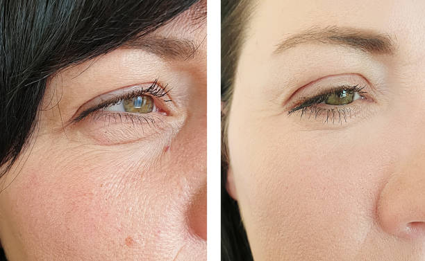 woman face wrinkles before and after treatment