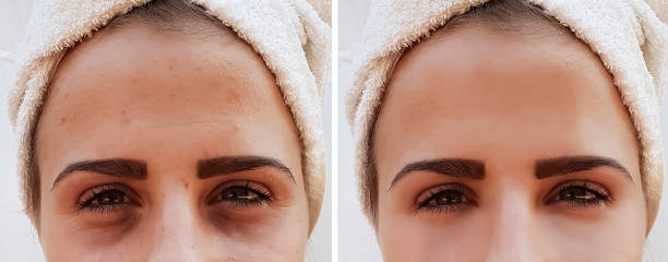 beautiful girl wrinkles on face before and after procedures, pimples