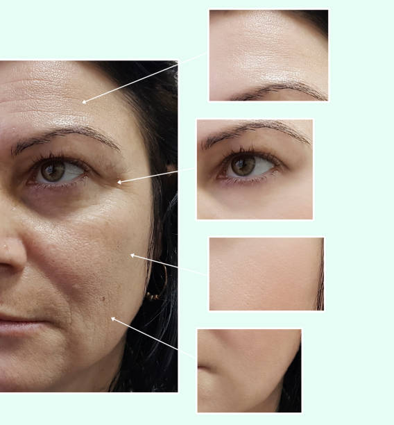 face woman wrinkles eyes before and after procedures, pigmentation