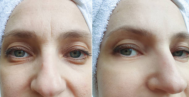 woman face wrinkles before and after treatment