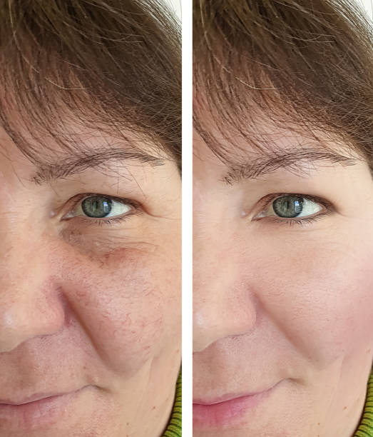 face of an elderly woman face wrinkles before and after procedures