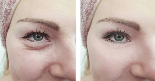 woman wrinkles before and after correction procedures