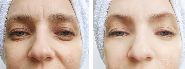 woman face wrinkles before and after treatment