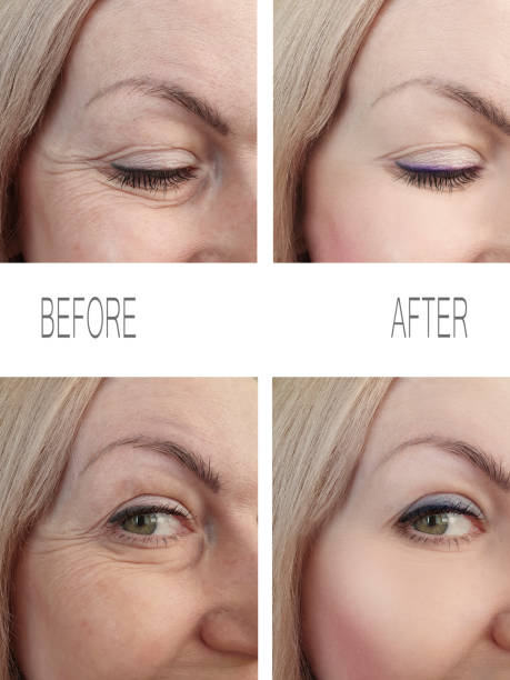 woman wrinkles face before and after procedures