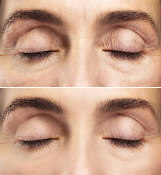 Anti aging treatment. Comparison of female eyes before and after rejuvenation.