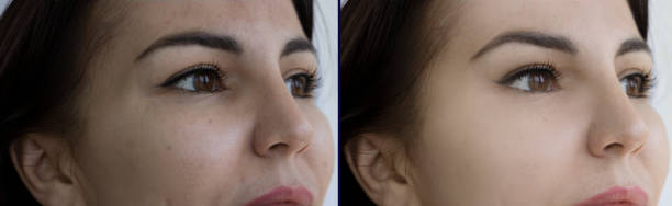 woman face wrinkles before and after treatment