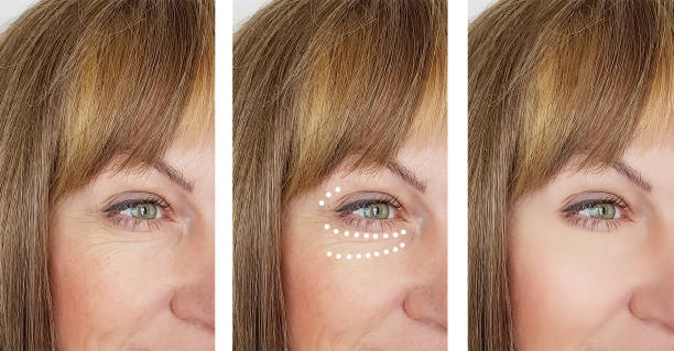 woman wrinkles before and after treatments retouching