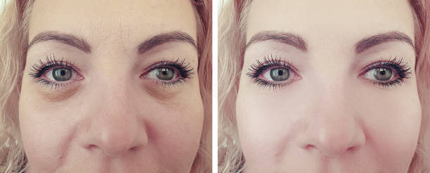 woman face eyes wrinkles before and after procedures