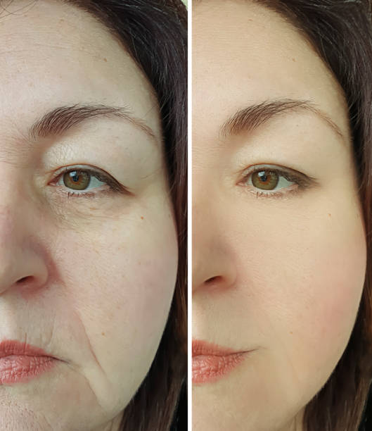 woman face wrinkles face before and after treatment