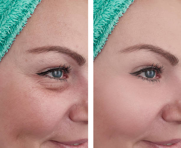 woman face
wrinkles before and after treatments