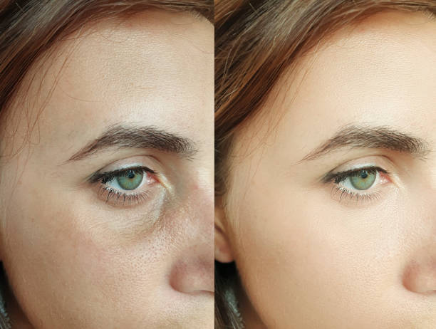 woman face wrinkles before and after treatment collage