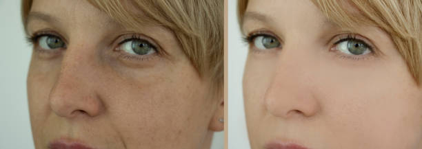 woman face wrinkles before and after treatment