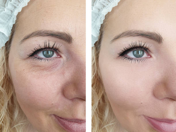 woman face wrinkles before and after treatment