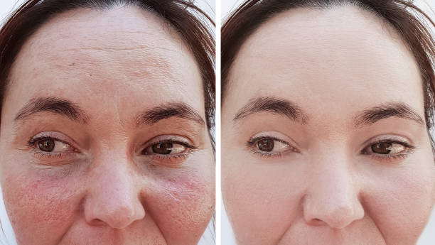 female wrinkles before and after correction procedures