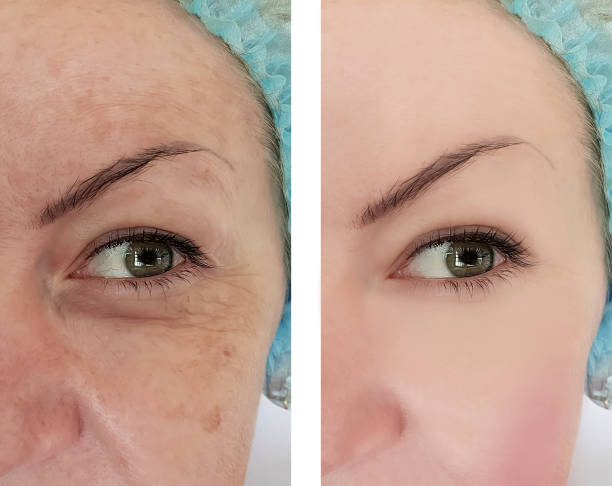 woman wrinkles before and after treatments
