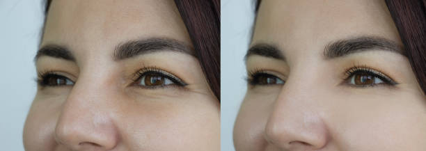 woman face wrinkles before and after treatment