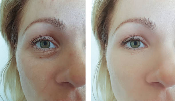woman face wrinkles before and after treatment